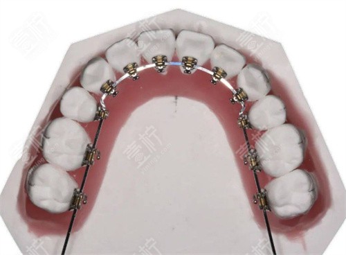 牙齿矫正器图