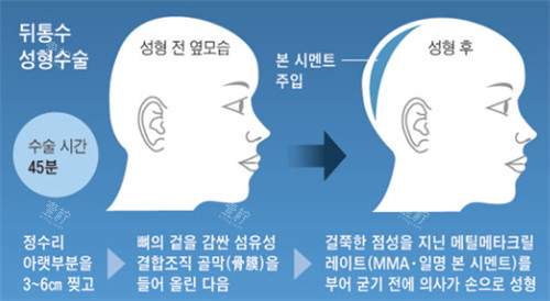 骨水泥填充后脑勺过程图解