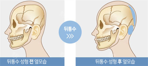 后脑勺填充前后头型的变化