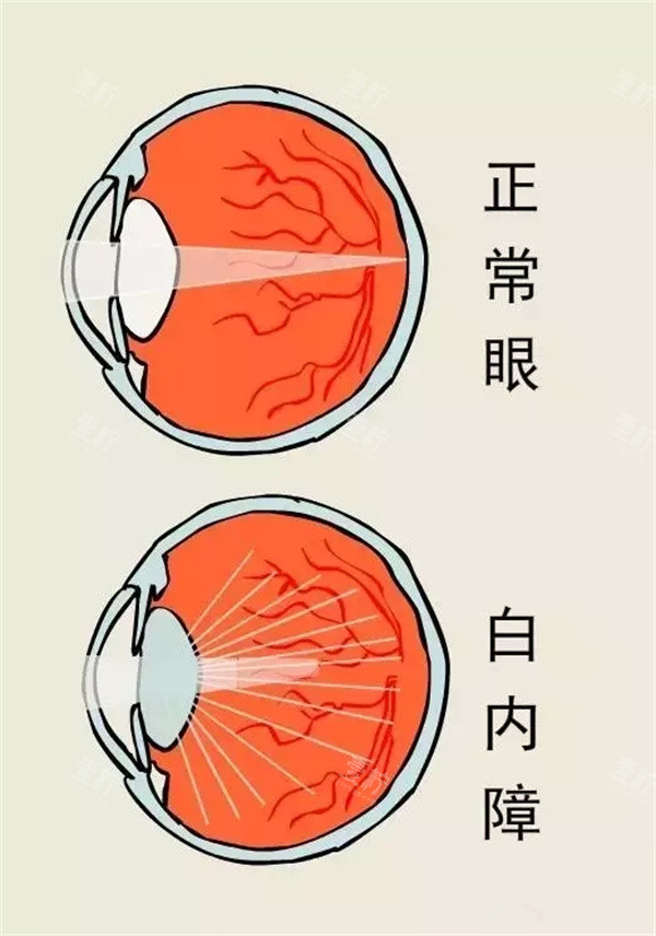 正常眼睛和白内障眼睛区别