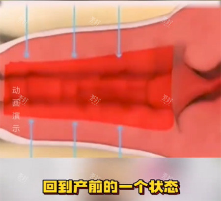 女性私密收紧针照片