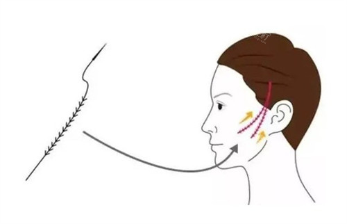 倒刺线提升素材 倒刺线提升素材