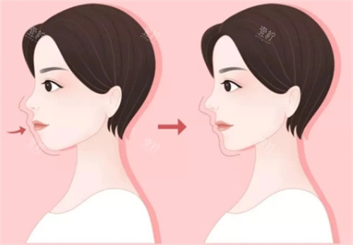 如何分辨自己是不是凸嘴
