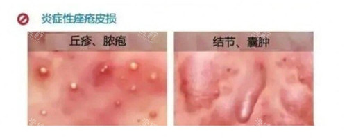 炎症性痤疮照片