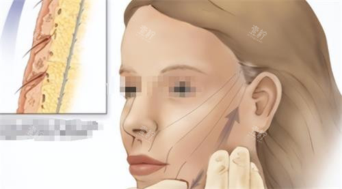 面部青春肽支架提升示意图