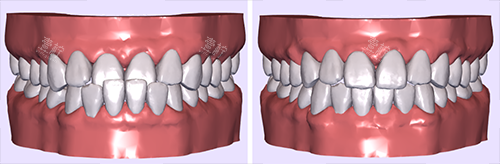 牙齿矫正模拟图前后对比