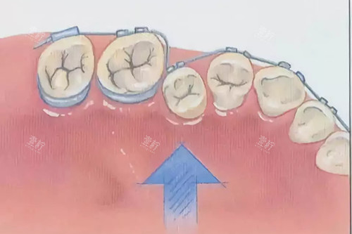 牙齿矫正示意图