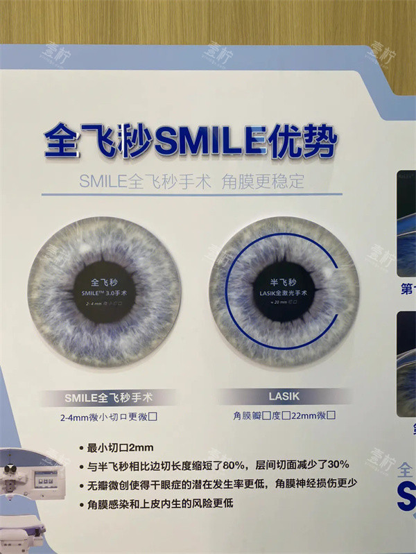 全飞秒SMILE优势 全飞秒SMILE优势
