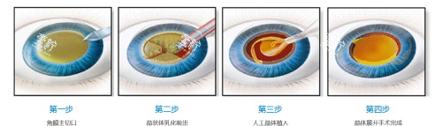 单焦晶体和多焦晶体8