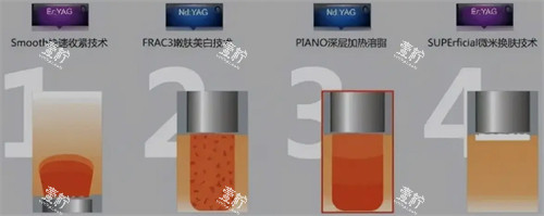 fotona4d欧洲之星四种模式