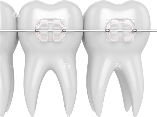 牙齿矫正陶瓷托槽漫画图 牙齿矫正陶瓷托槽漫画图
