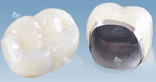 爱迪特全瓷牙 爱迪特全瓷牙