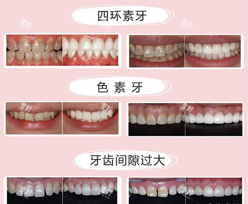 不同牙齿需要美白的示意图