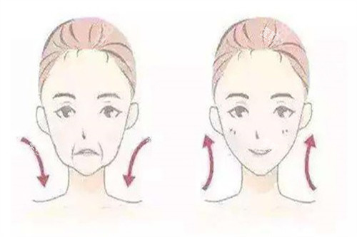 拉皮面部提升对比卡通示意图