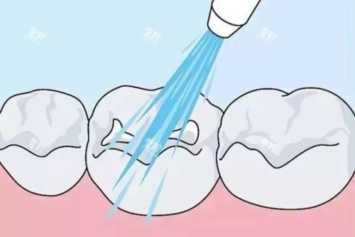 儿牙涂氟卡通图