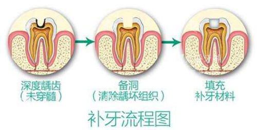 补牙流程图示意图