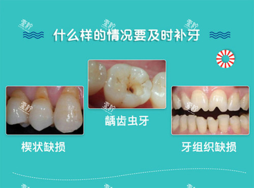 补牙适应症