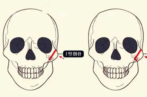 颧骨磨骨整形卡通示意图