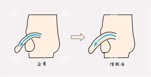 增粗术前后对比