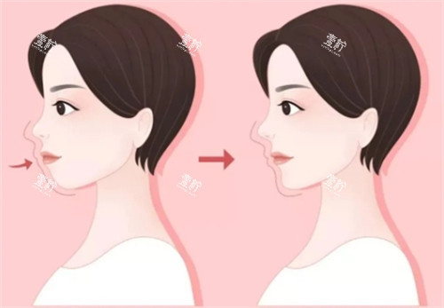 如何分辨自己是不是凸嘴