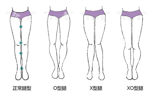 O型腿和X型腿对比图