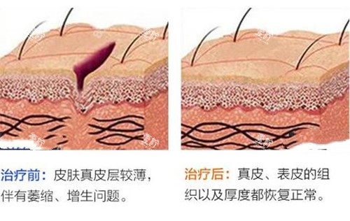 激光祛疤前后对比示意图