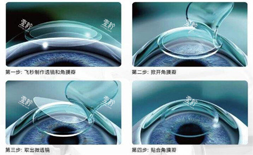 飞秒手术3.0
