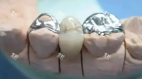 镶牙治疗细节图