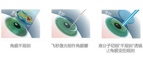 准分子激光 准分子激光