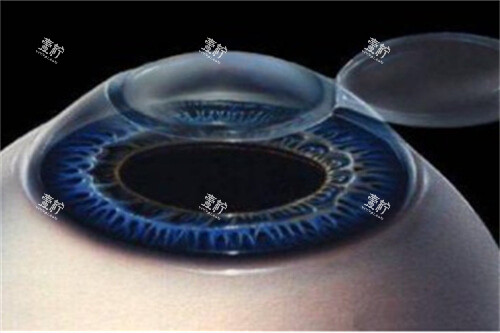 近视眼手术1 近视眼手术1