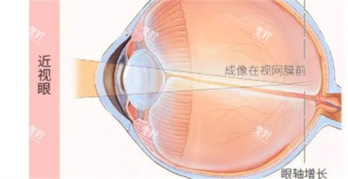 近视眼的成像 近视眼的成像