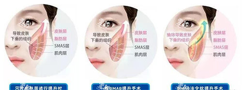 三类拉皮手术方法对比