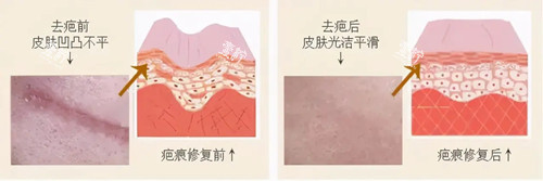 激光祛疤卡通示意图