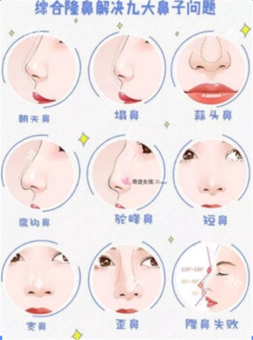 隆鼻
