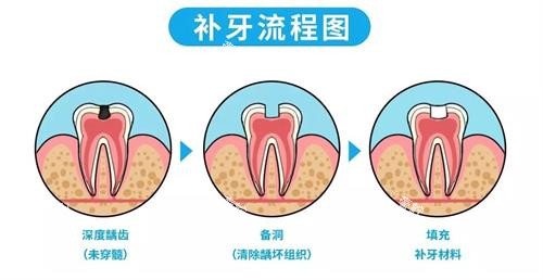 补牙的流程