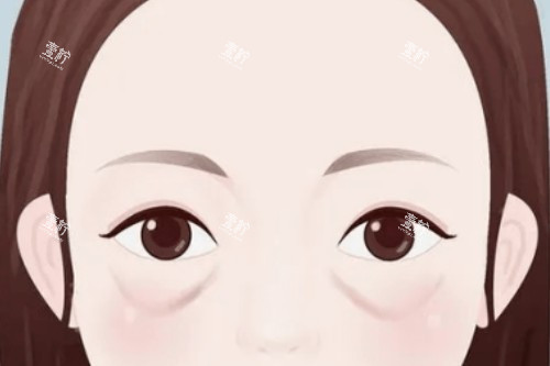 眼袋卡通展示图