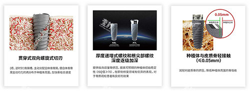 卡尔斯种植牙有什么不同