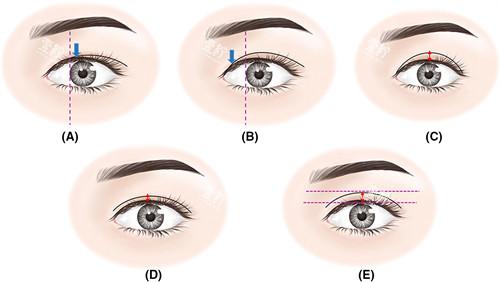 调整双眼皮宽度 调整双眼皮宽度