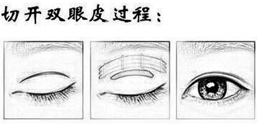 切开双眼皮 切开双眼皮