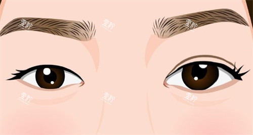 双眼皮手术术前术后对比卡通 双眼皮手术术前术后对比卡通