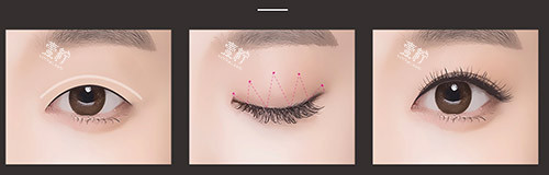 埋线双眼皮过程示意图 埋线双眼皮过程示意图