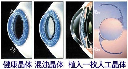 ICL晶体植入眼球对比示意图 ICL晶体植入眼球对比示意图