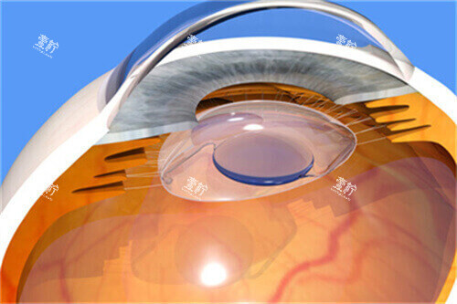 ICL晶体18 ICL晶体18