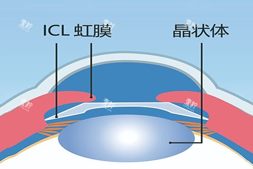 ICL晶体植入卡通图 ICL晶体植入卡通图