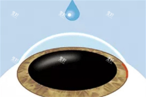 ICL晶体植入麻醉 ICL晶体植入麻醉