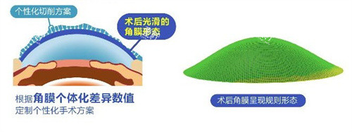 个性化飞秒术后角膜 个性化飞秒术后角膜