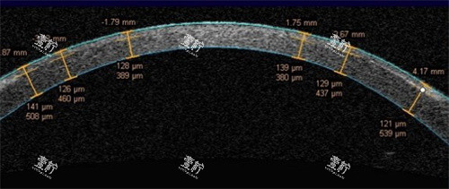 飞秒激光角膜瓣厚度 飞秒激光角膜瓣厚度