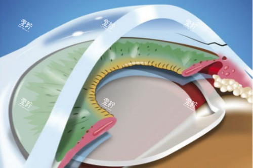 放入白内障晶体 放入白内障晶体