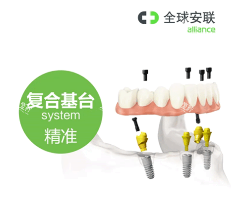安联种植牙复合基台照片 安联种植牙复合基台照片
