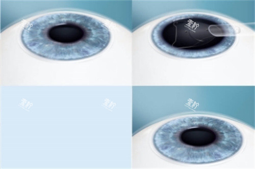 ICL晶体植入手术过程图 ICL晶体植入手术过程图